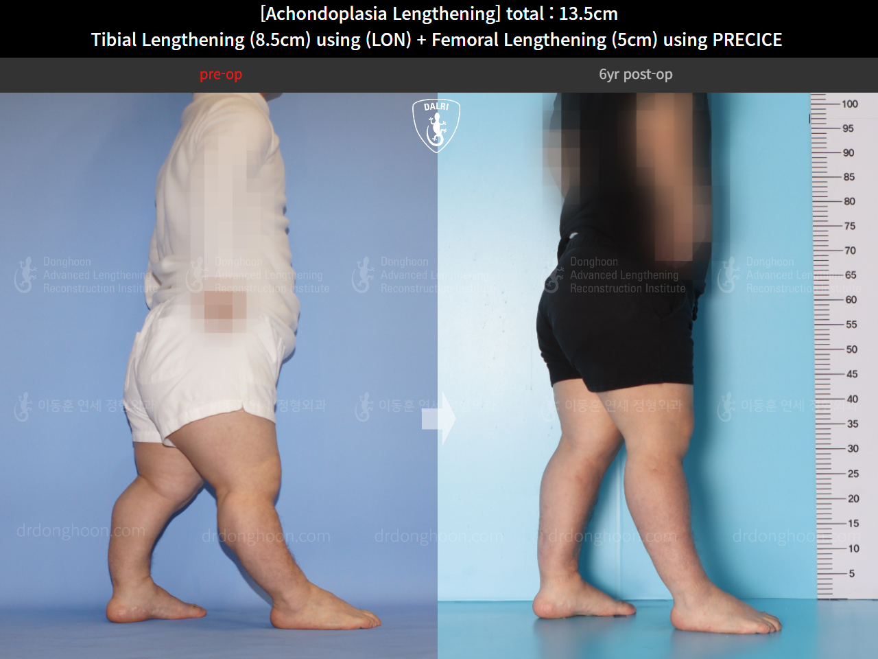 Before and after cll lon, case 14993527, image 8, Dr. Donghoon institute (DALRI)