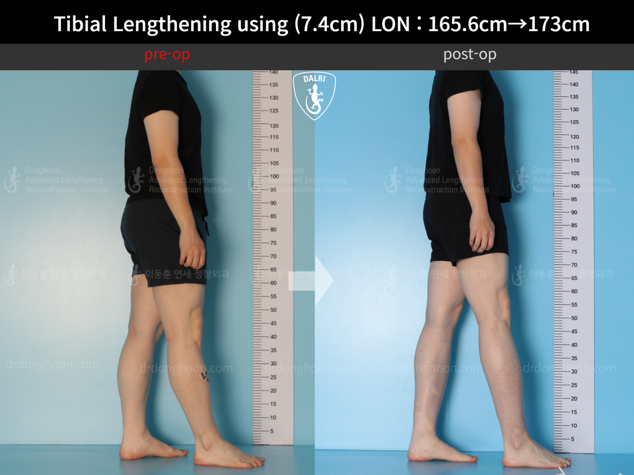 Before and after cll lon, case 13634644, image 4, Dr. Donghoon institute (DALRI)