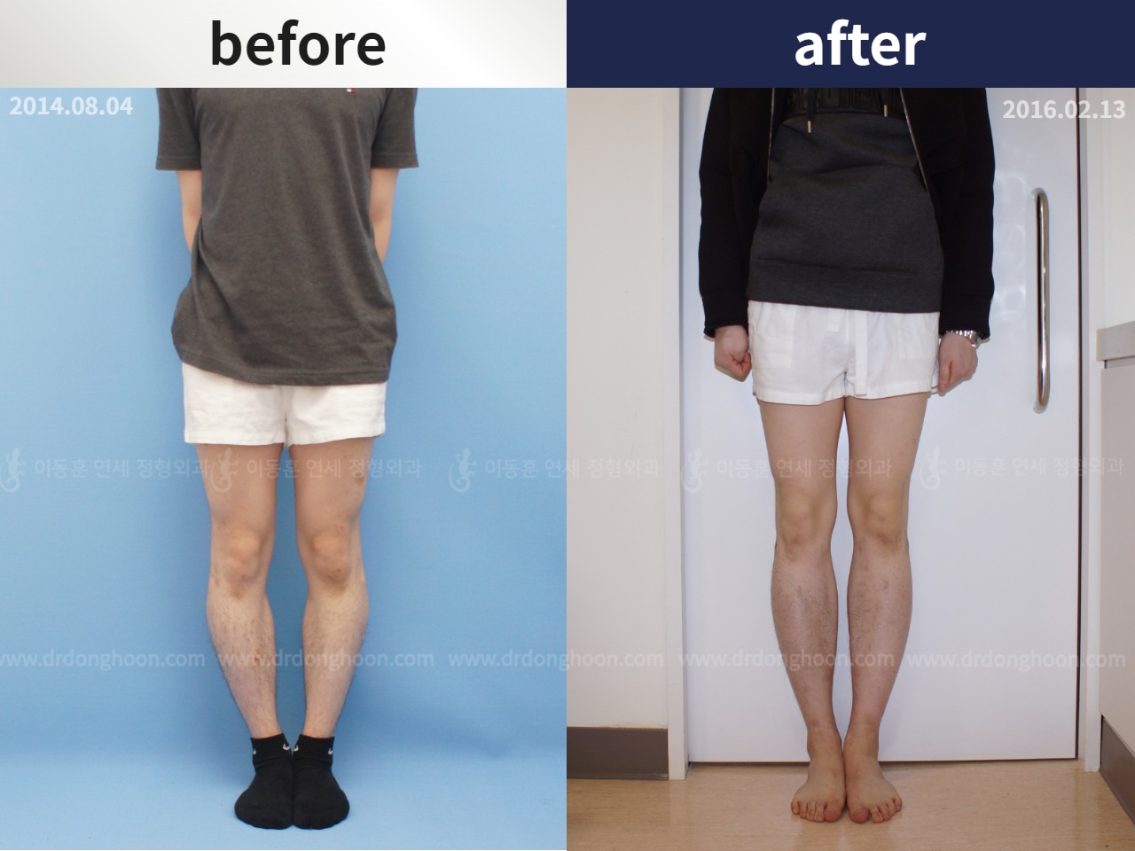 Before and after cll + deformity correction, case 4323134, image 1, Dr. Donghoon institute (DALRI)