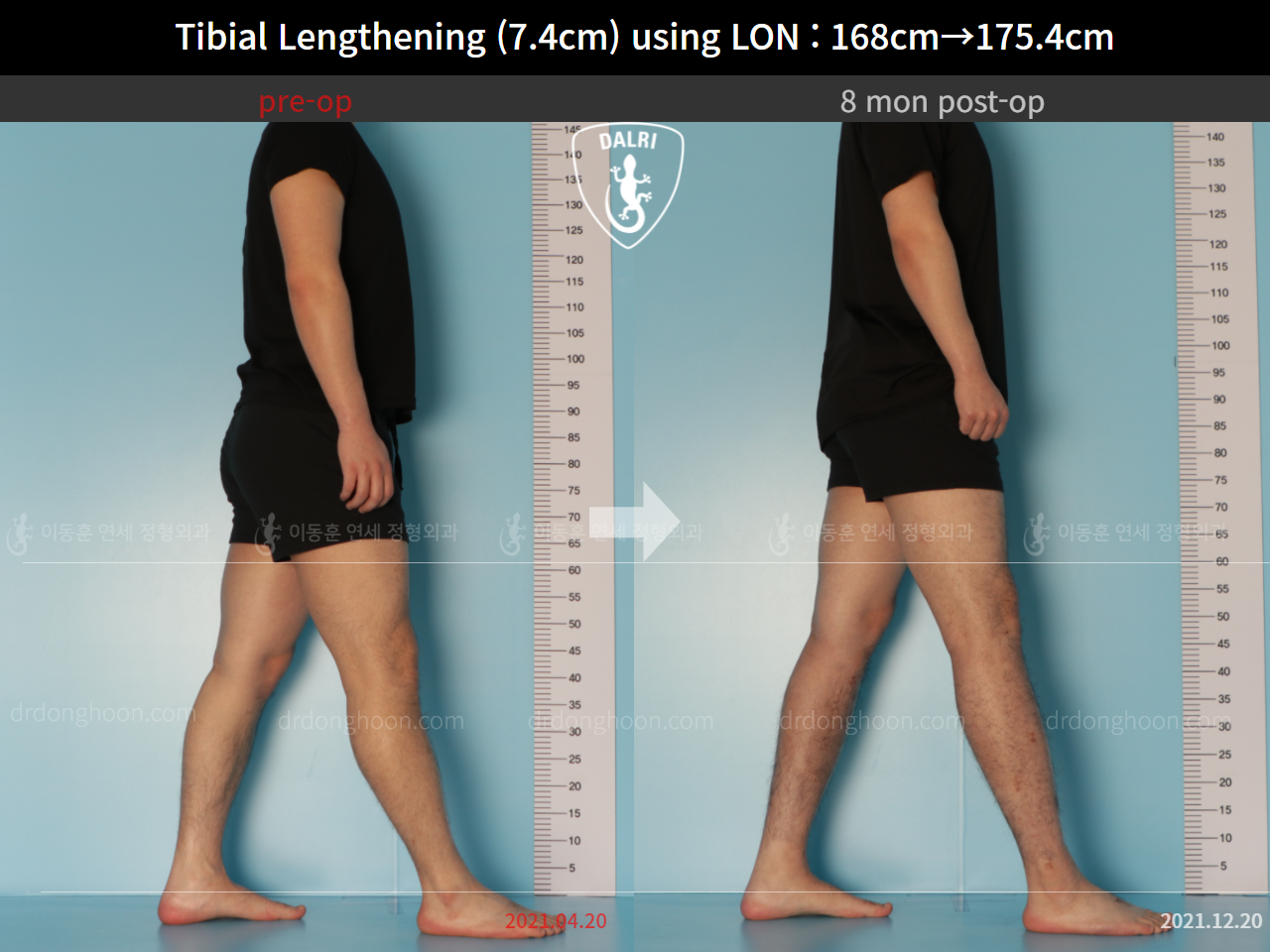 Before and after cll lon, case 9188051, image 4, Dr. Donghoon institute (DALRI)