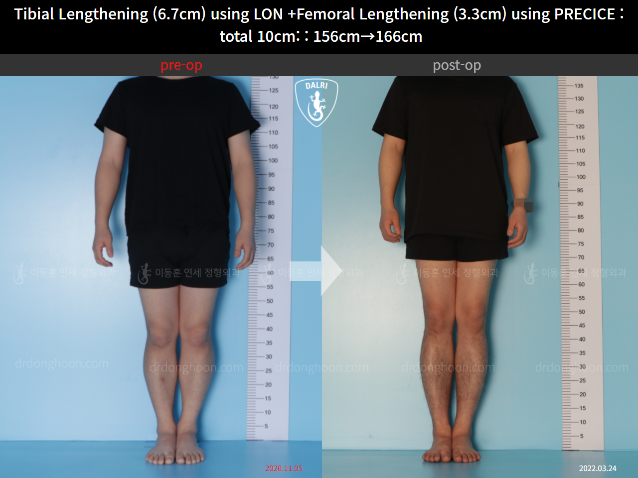 Before and after cll lon, case 11044268, image 1, Dr. Donghoon institute (DALRI)