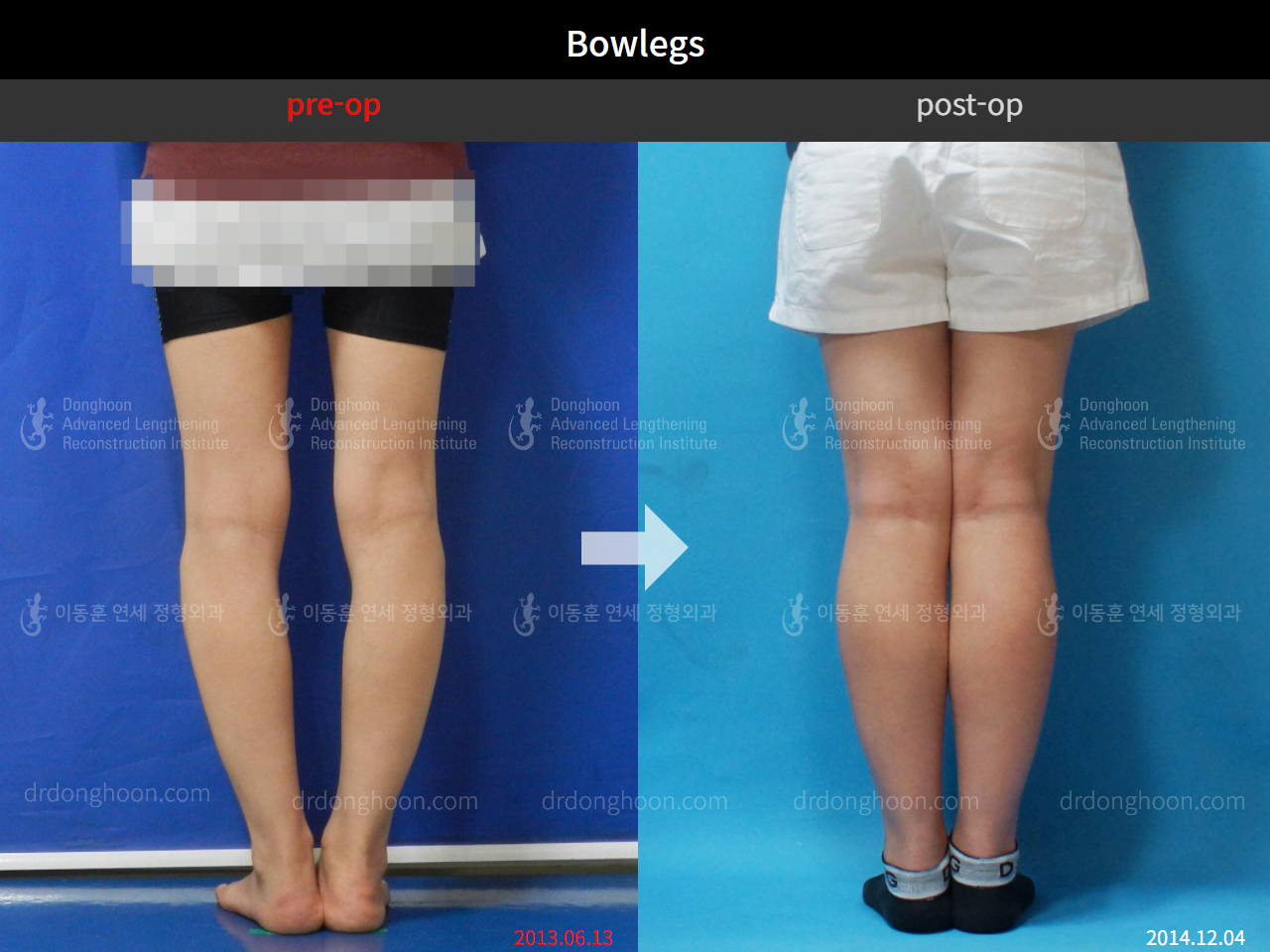 Before and after adult bowlegs, case 4310996, image 4, Dr. Donghoon institute (DALRI)