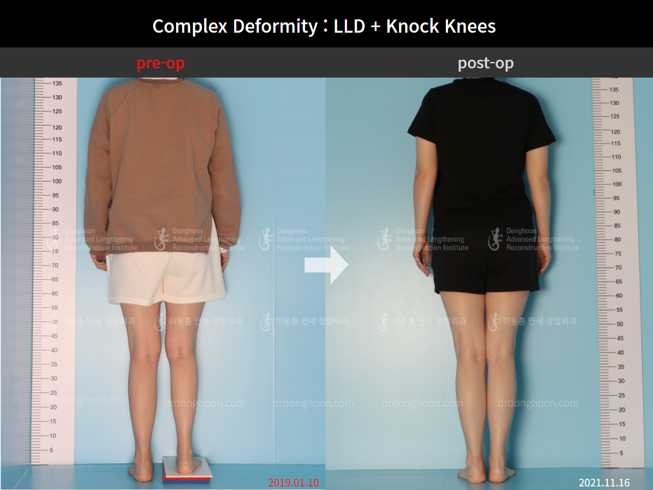 Before and after adult lld, case 9041582, image 7, Dr. Donghoon institute (DALRI)