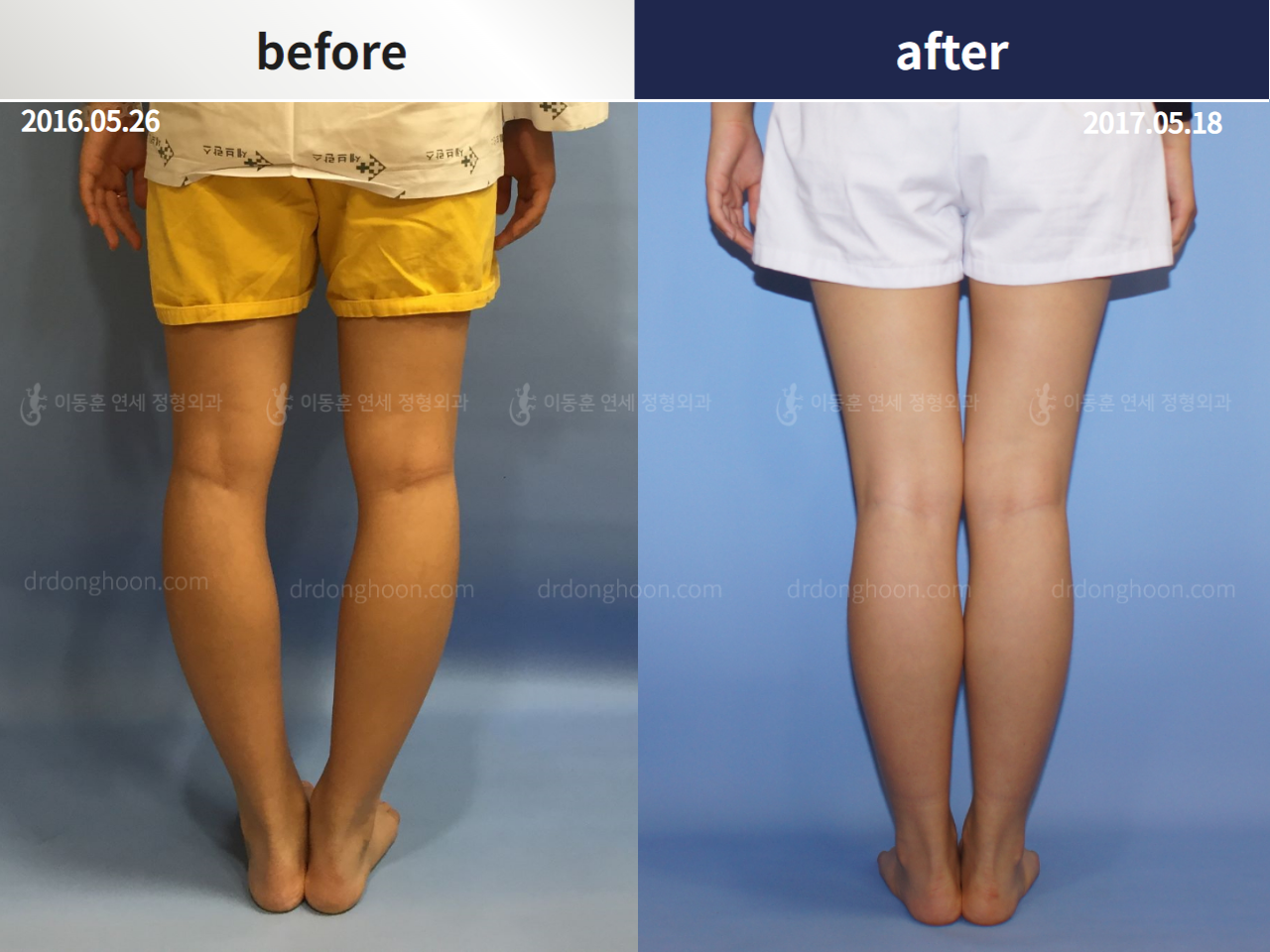 Before and after complex deformity, case 4251615, image 4, Dr. Donghoon institute (DALRI)
