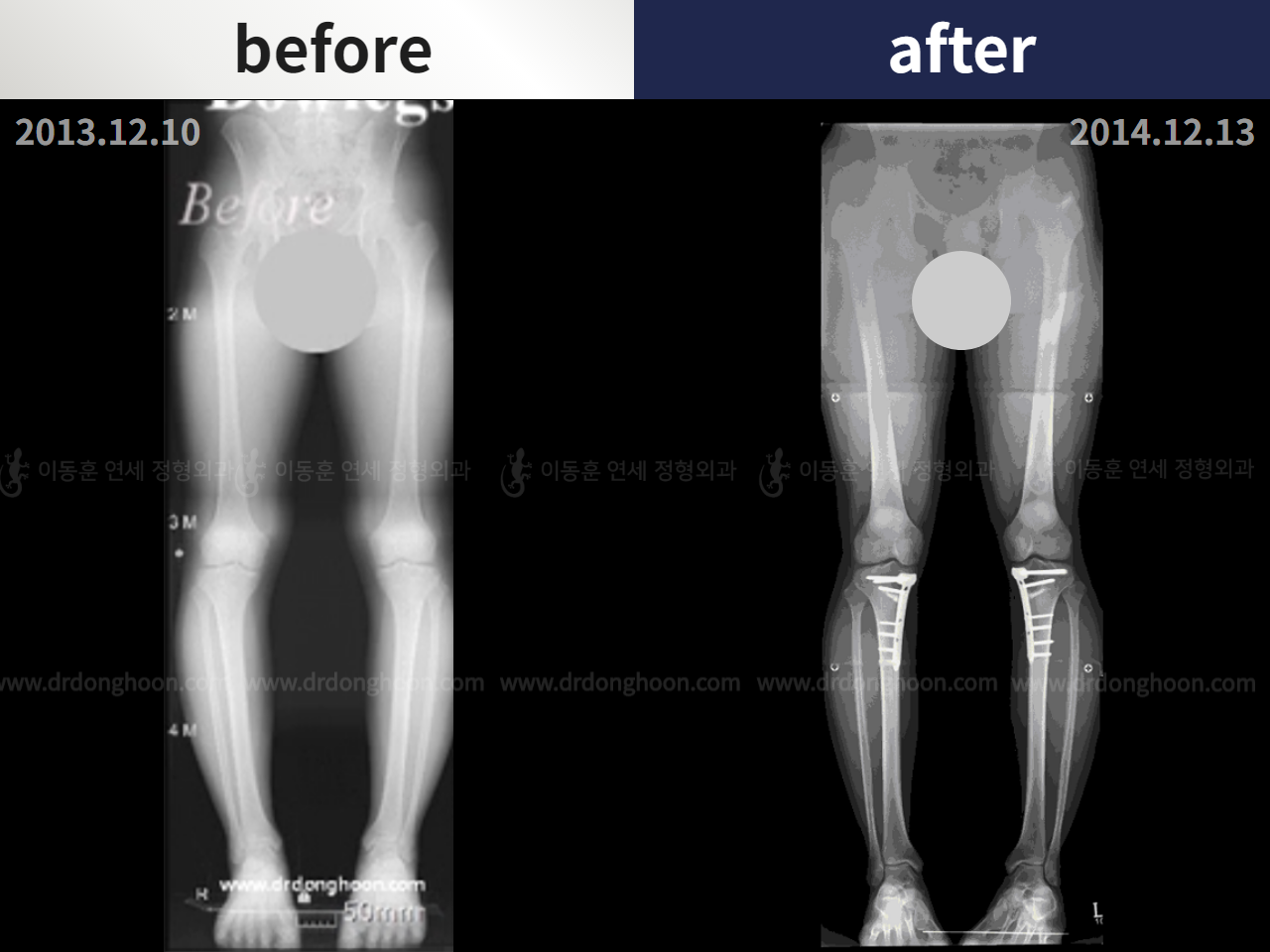 Before and after paediatric & adolescent bowlegs, case 4320236, image 2, Dr. Donghoon institute (DALRI)