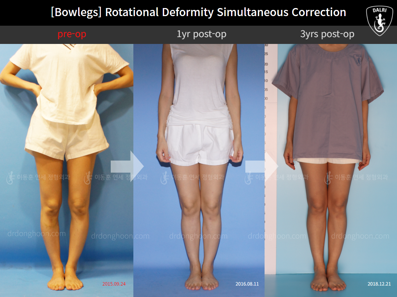 Before and after adult bowlegs, case 11789553, image 2, Dr. Donghoon institute (DALRI)