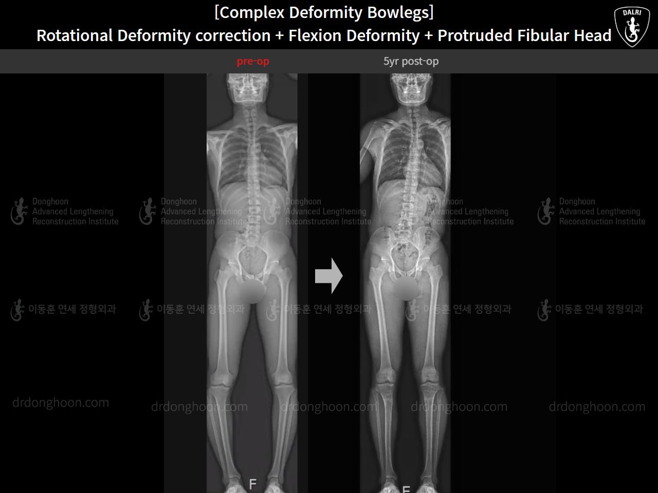 Before and after complex deformity, case 15944755, image 12, Dr. Donghoon institute (DALRI)