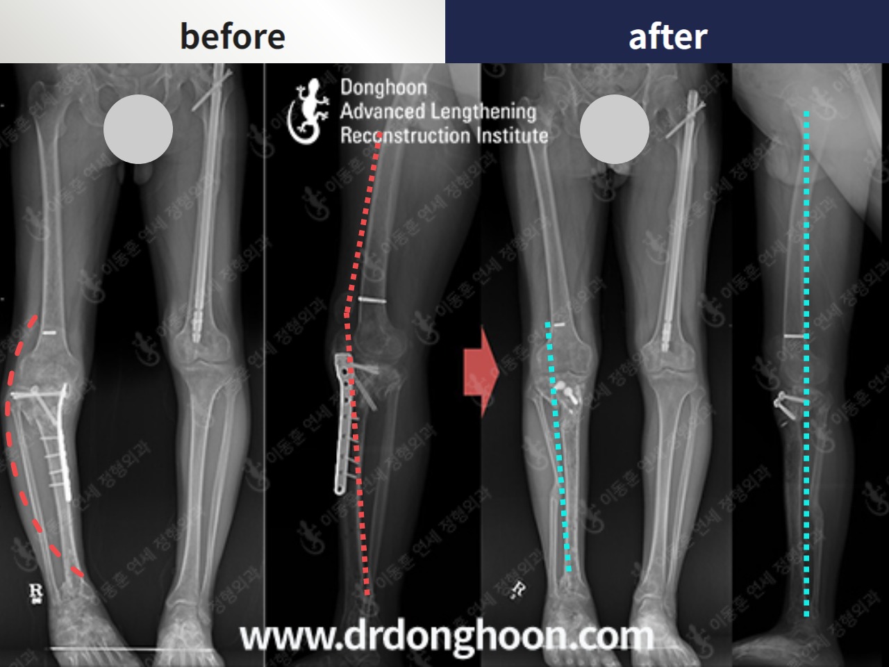 Before and after complex deformity, case 4762607, image 1, Dr. Donghoon institute (DALRI)