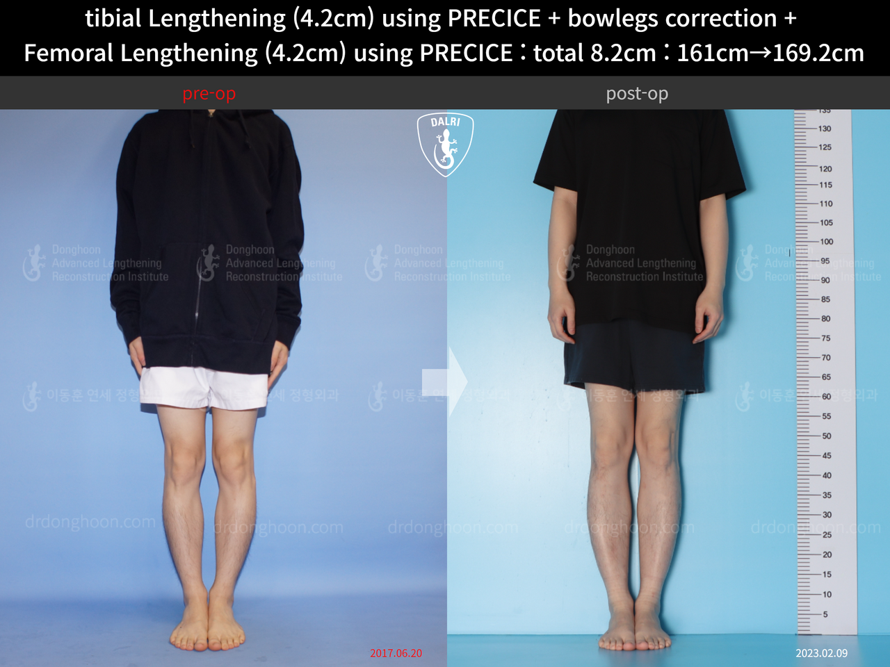 Before and after cll precice, case 14235714, image 1, Dr. Donghoon institute (DALRI)