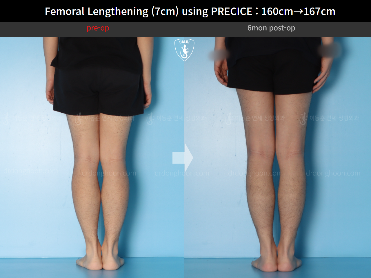 Before and after cll precice, case 15460533, image 10, Dr. Donghoon institute (DALRI)