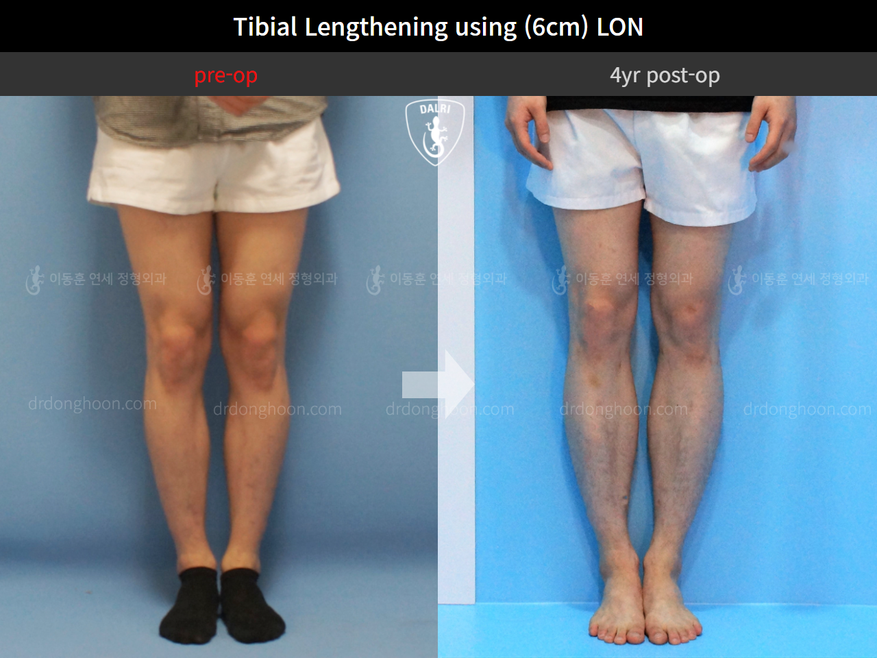 Before and after cll lon, case 4323452, image 5, Dr. Donghoon institute (DALRI)
