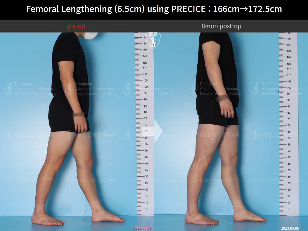Before and after cll precice, case 14706614, image 8, Dr. Donghoon institute (DALRI)