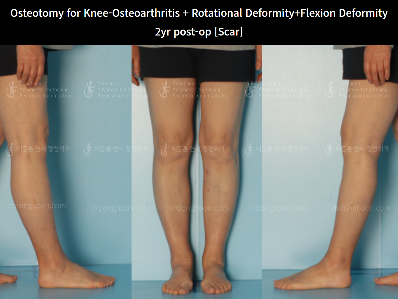 Before and after osteotomy for knee osteoarthritis, case 5987662, image 6, Dr. Donghoon institute (DALRI)