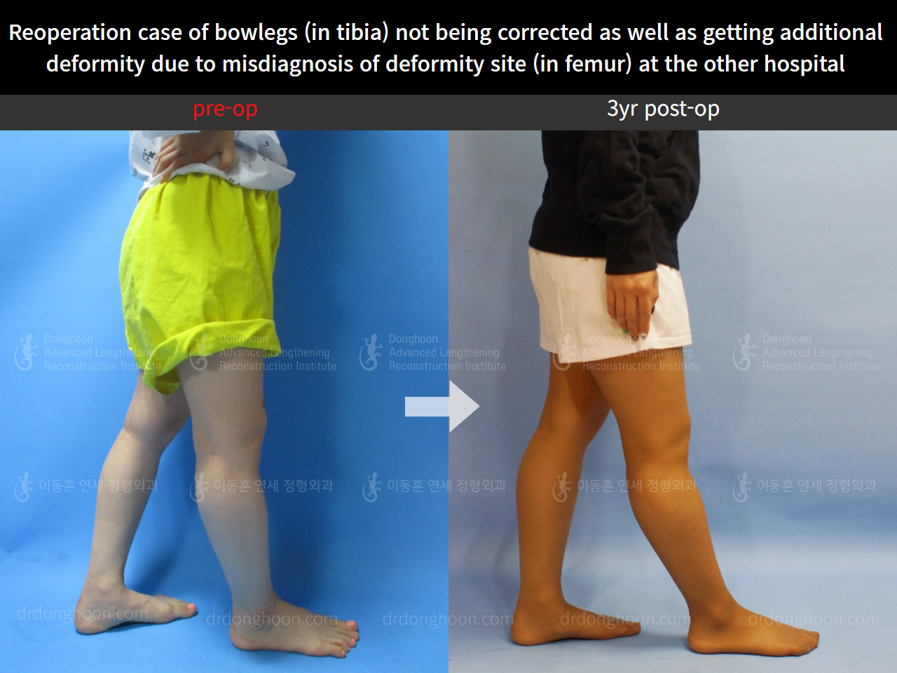 Before and after reoperation after deformity correction, case 5306623, image 5, Dr. Donghoon institute (DALRI)