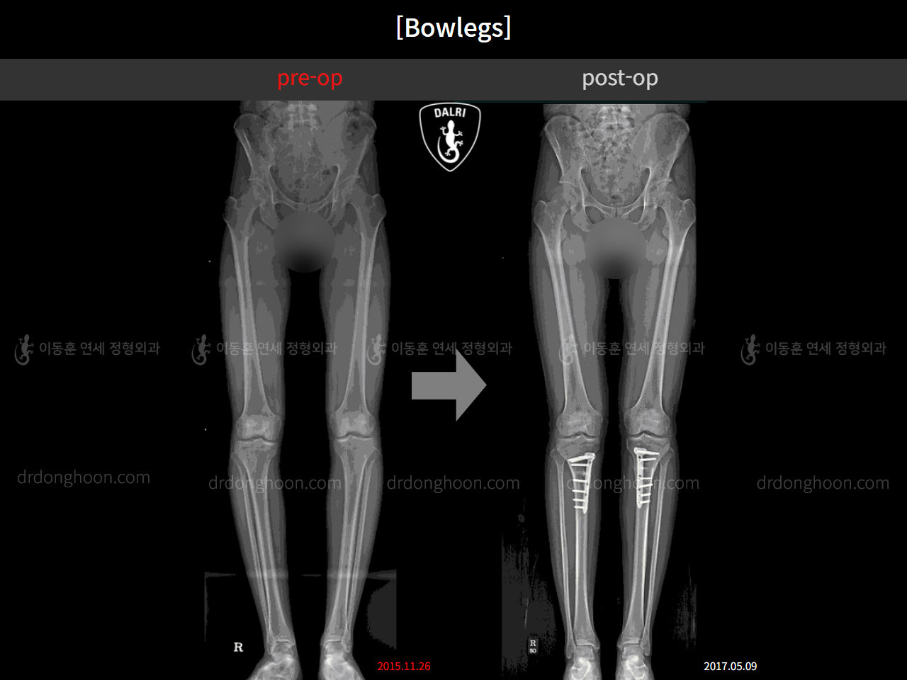 Before and after adult bowlegs, case 9680227, image 3, Dr. Donghoon institute (DALRI)