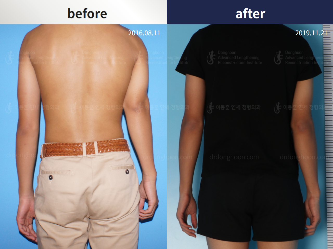 Before and after arm lengthening, case 4249350, image 3, Dr. Donghoon institute (DALRI)