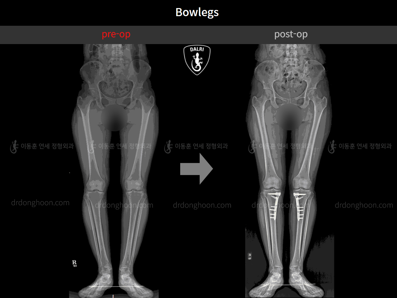 Before and after adult bowlegs, case 4310980, image 3, Dr. Donghoon institute (DALRI)