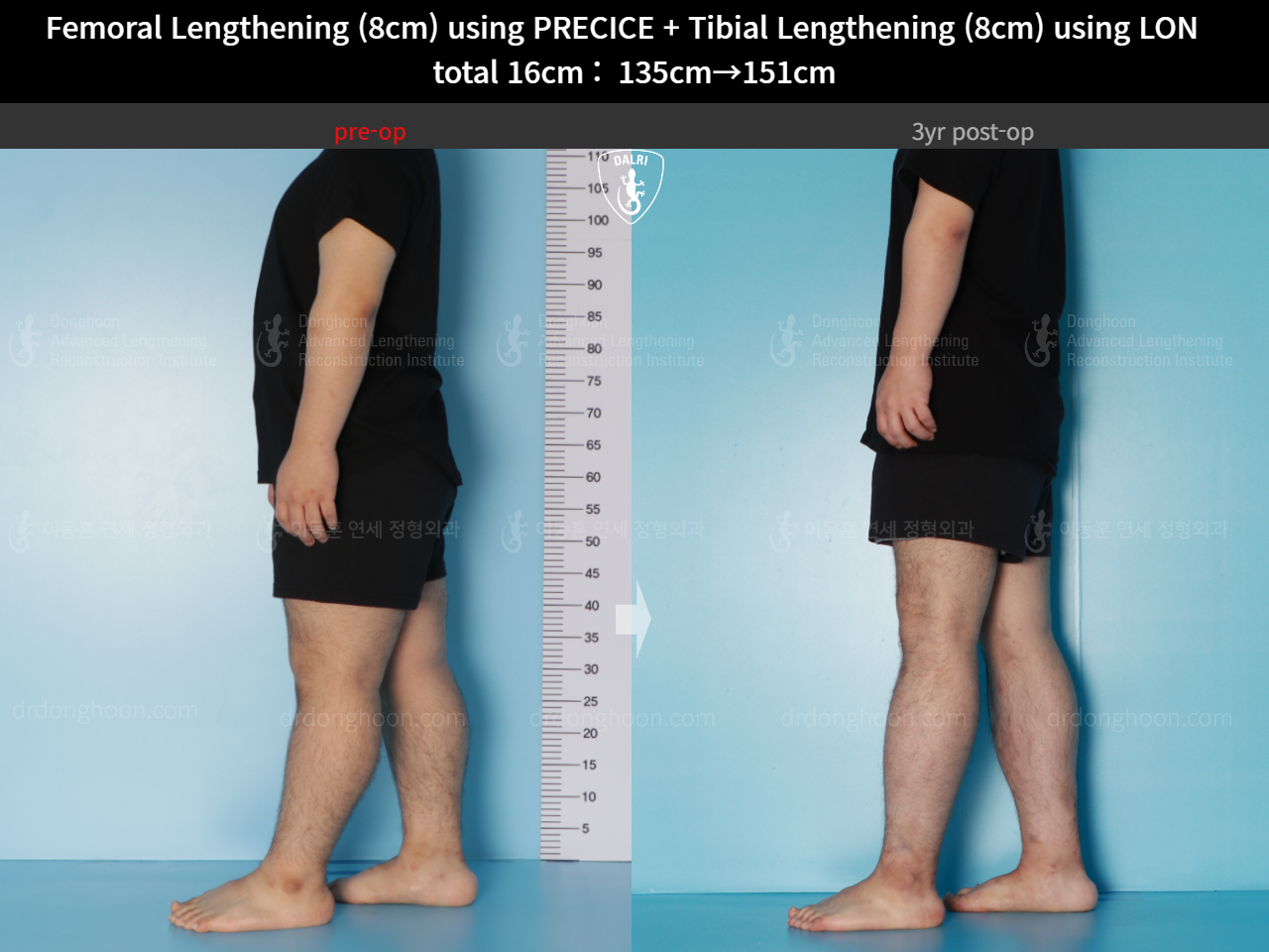Before and after cll lon, case 16524730, image 8, Dr. Donghoon institute (DALRI)