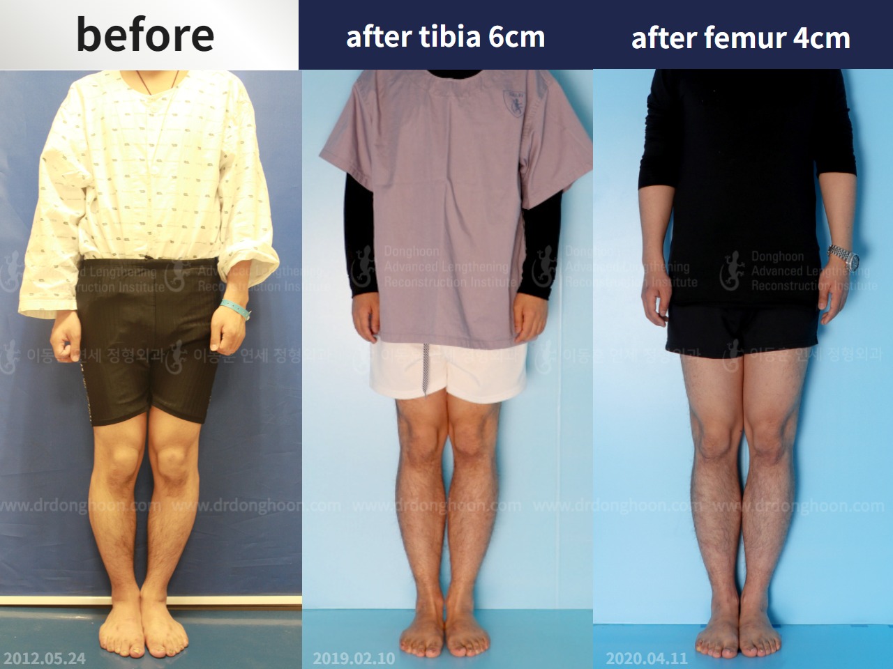 Before and after cll precice, case 4573572, image 1, Dr. Donghoon institute (DALRI)
