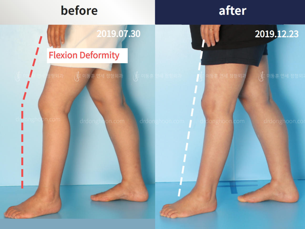 Before and after flexion deformity, case 4251737, image 2, Dr. Donghoon institute (DALRI)