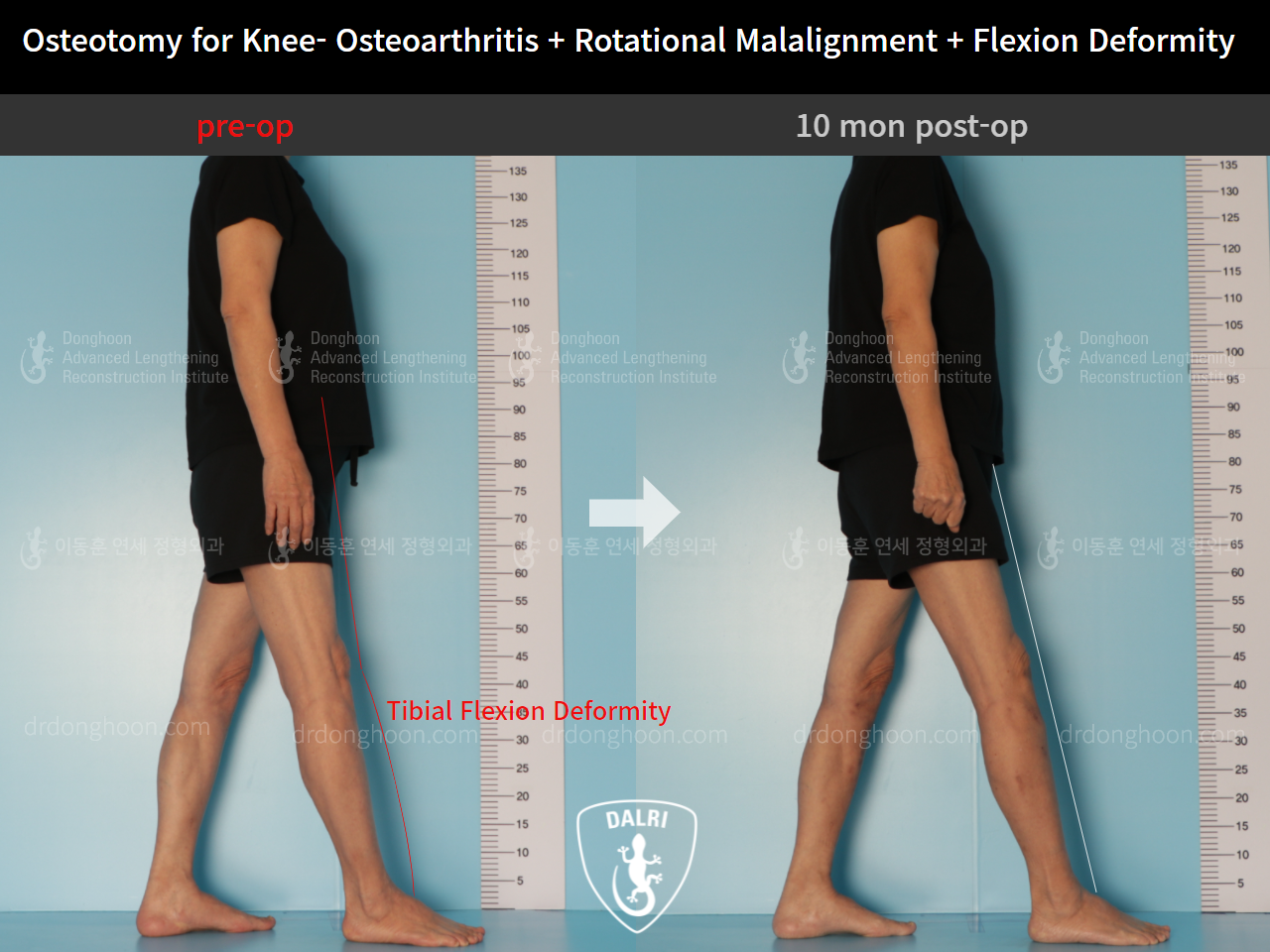 Before and after osteotomy for knee osteoarthritis, case 9128503, image 6, Dr. Donghoon institute (DALRI)