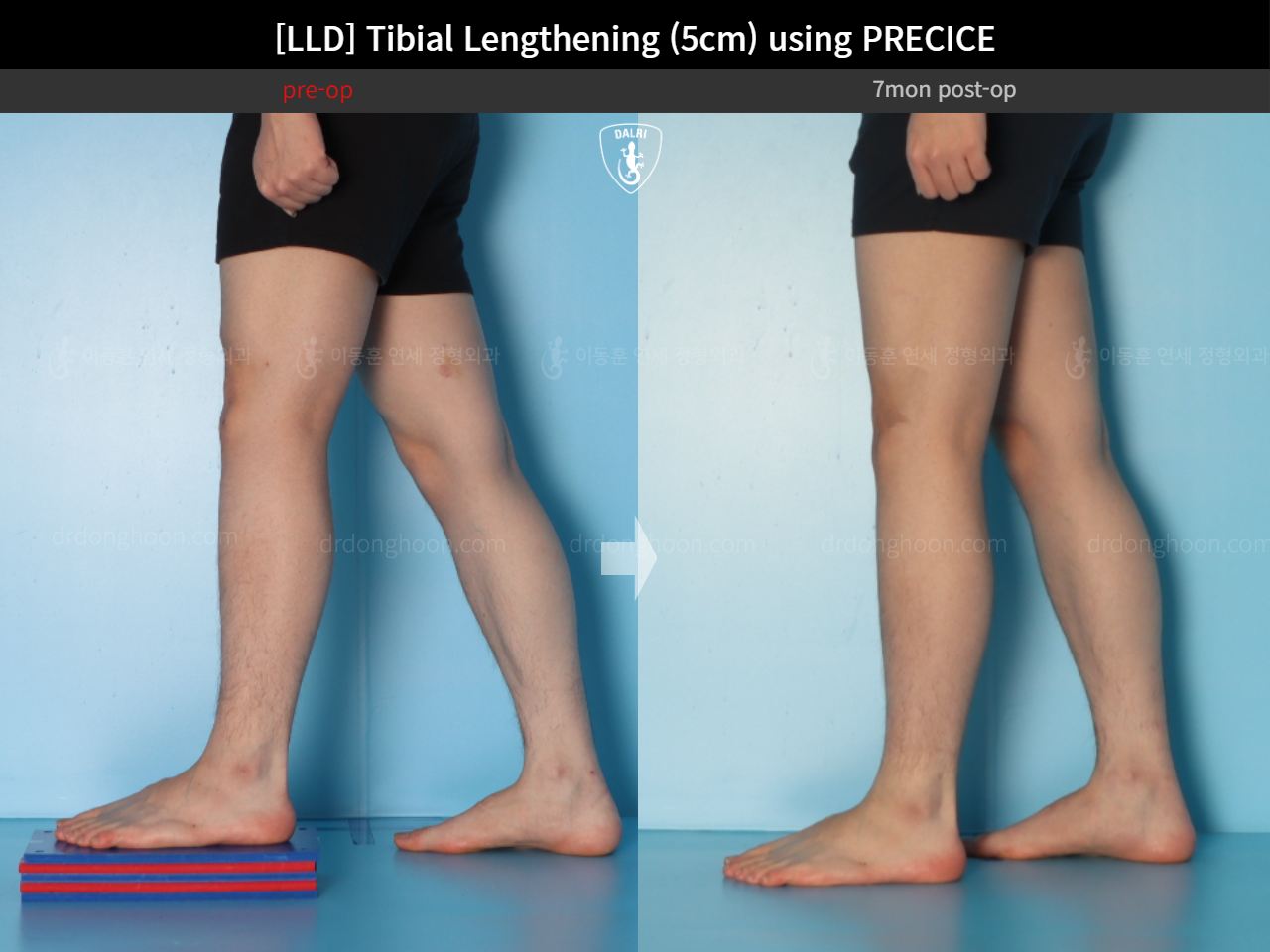 Before and after adult lld, case 18471613, image 7, Dr. Donghoon institute (DALRI)