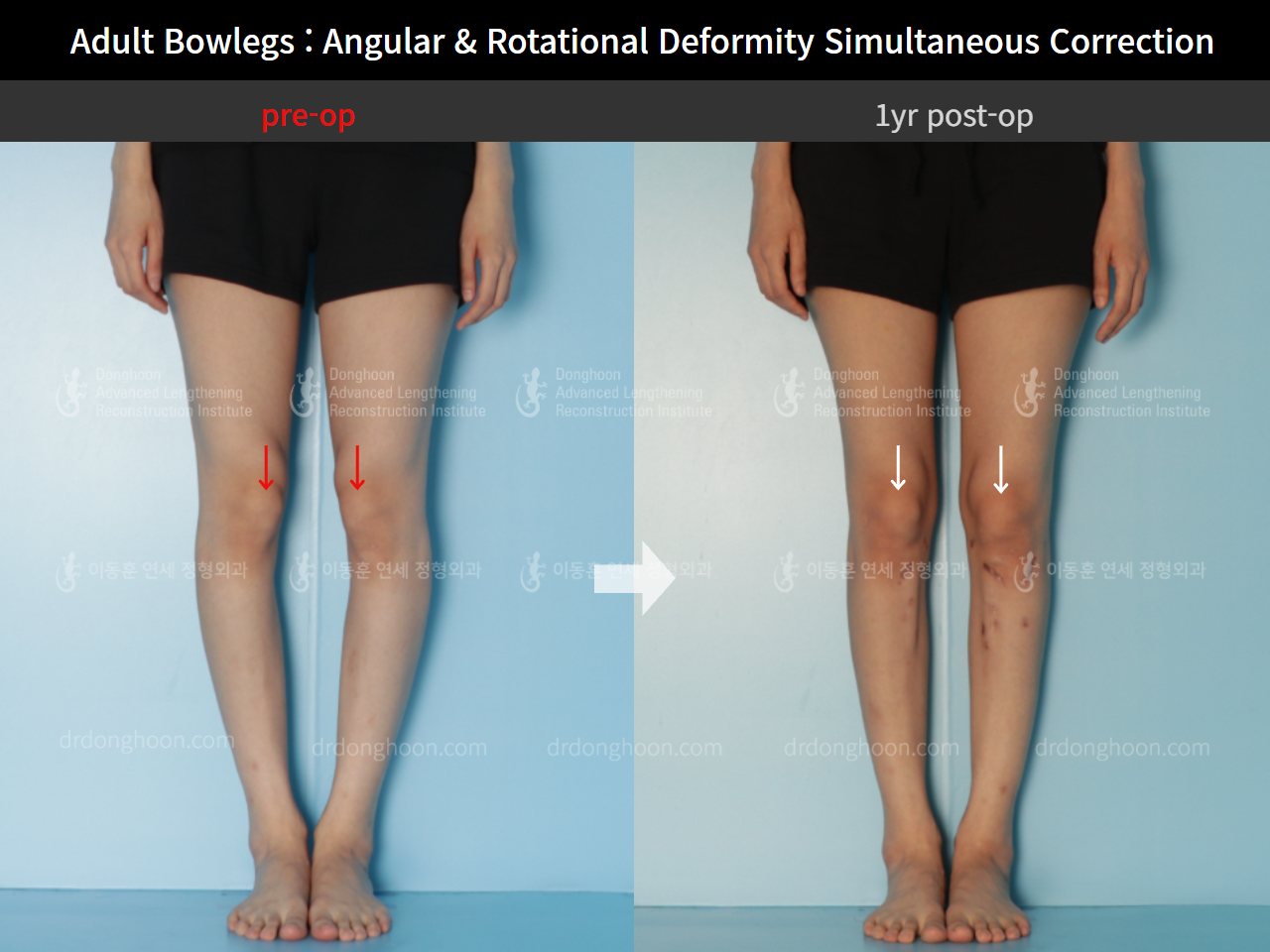 Before and after adult bowlegs, case 9058125, image 4, Dr. Donghoon institute (DALRI)