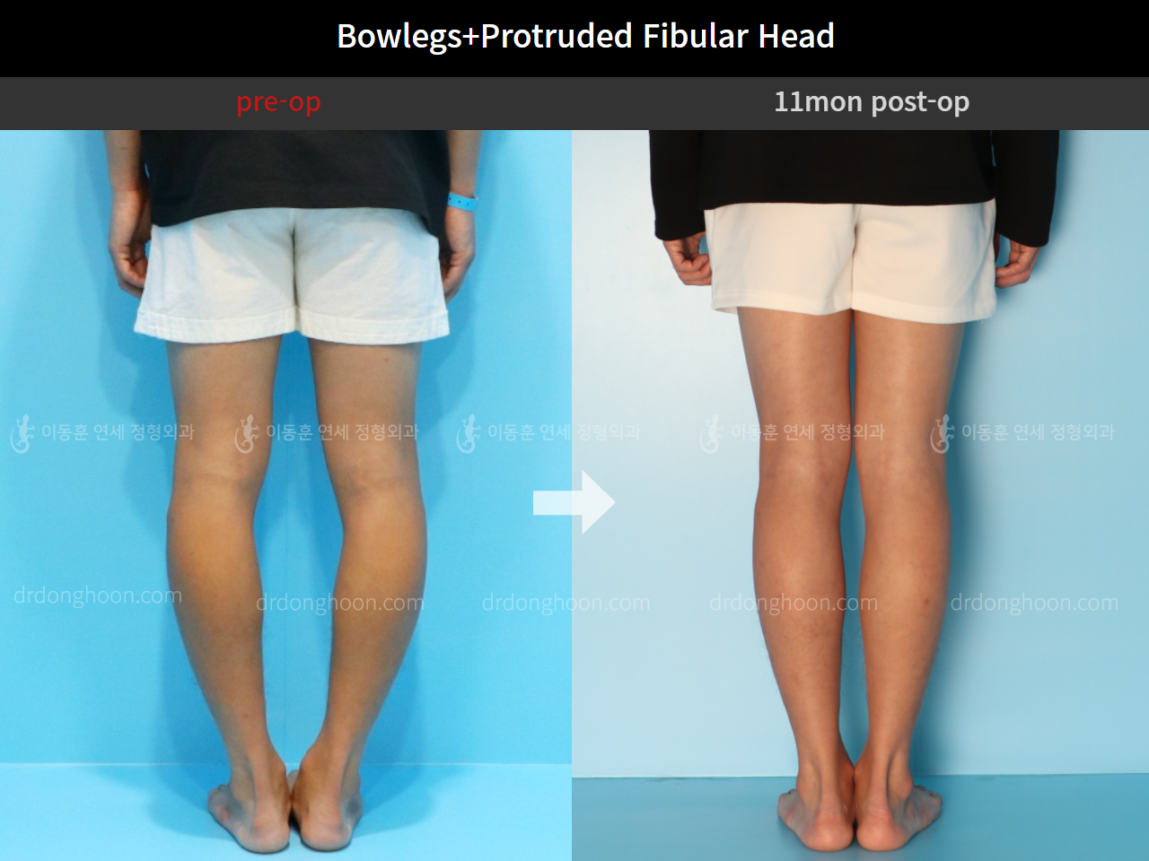 Before and after protruded fibular head, case 4248372, image 5, Dr. Donghoon institute (DALRI)