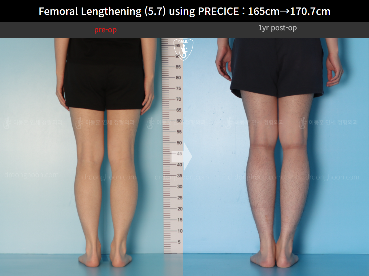Before and after cll precice, case 15417090, image 8, Dr. Donghoon institute (DALRI)