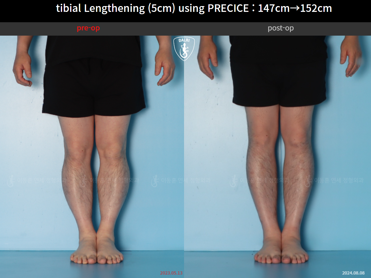 Before and after cll precice, case 89098588, image 7, Dr. Donghoon institute (DALRI)