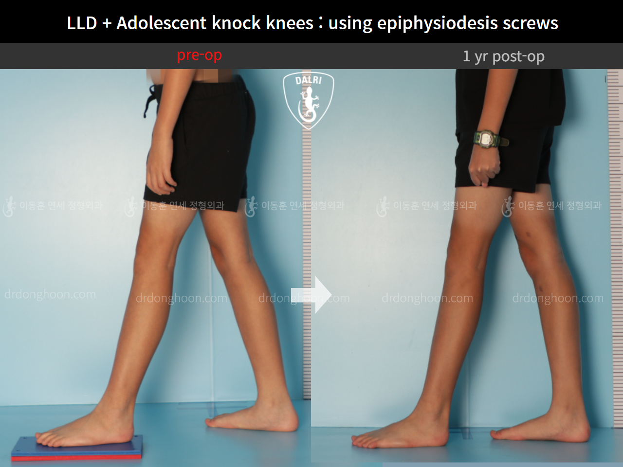 Before and after paediatric & adolescent knock knees, case 9186061, image 3, Dr. Donghoon institute (DALRI)