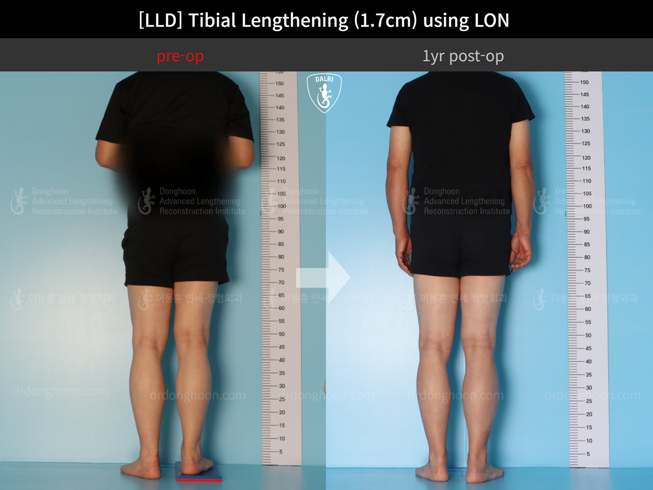 Before and after adult lld, case 13261805, image 2, Dr. Donghoon institute (DALRI)