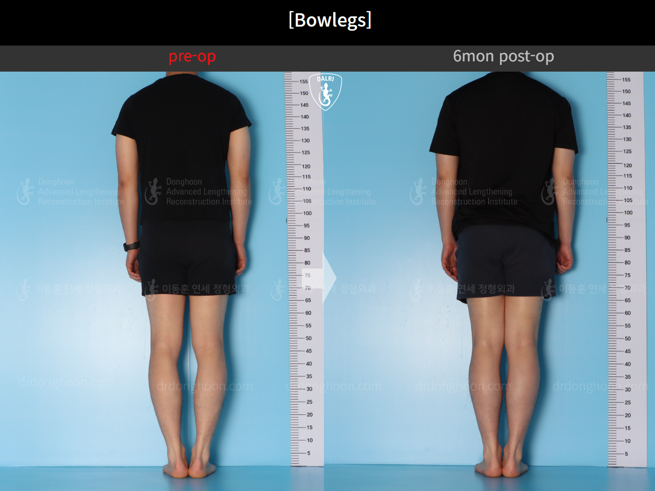 Before and after adult bowlegs, case 14742489, image 4, Dr. Donghoon institute (DALRI)