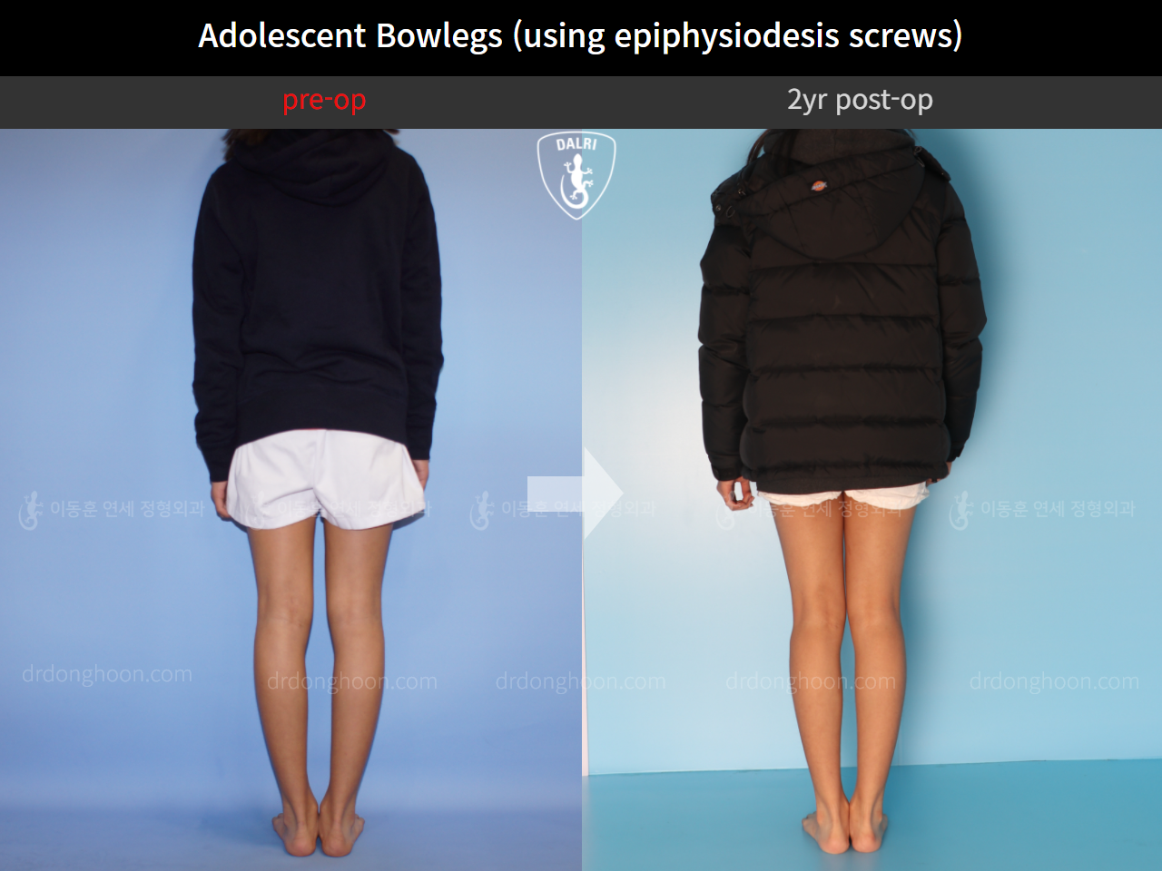 Before and after paediatric & adolescent bowlegs, case 4585777, image 2, Dr. Donghoon institute (DALRI)