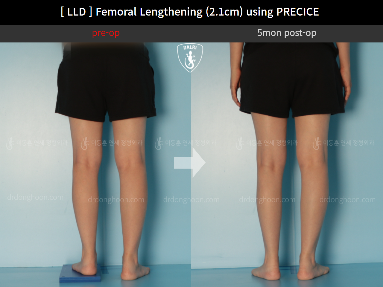 Before and after adult lld, case 11784618, image 5, Dr. Donghoon institute (DALRI)