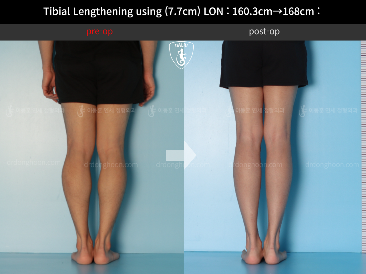 Before and after cll lon, case 12643440, image 6, Dr. Donghoon institute (DALRI)