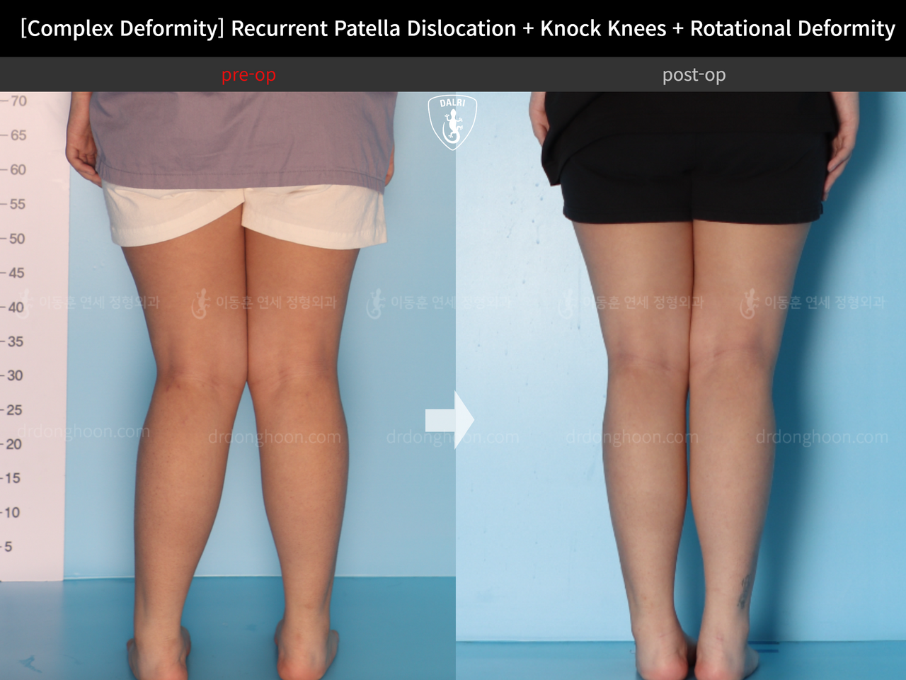 Before and after recurrent patella dislocation, case 14344405, image 4, Dr. Donghoon institute (DALRI)