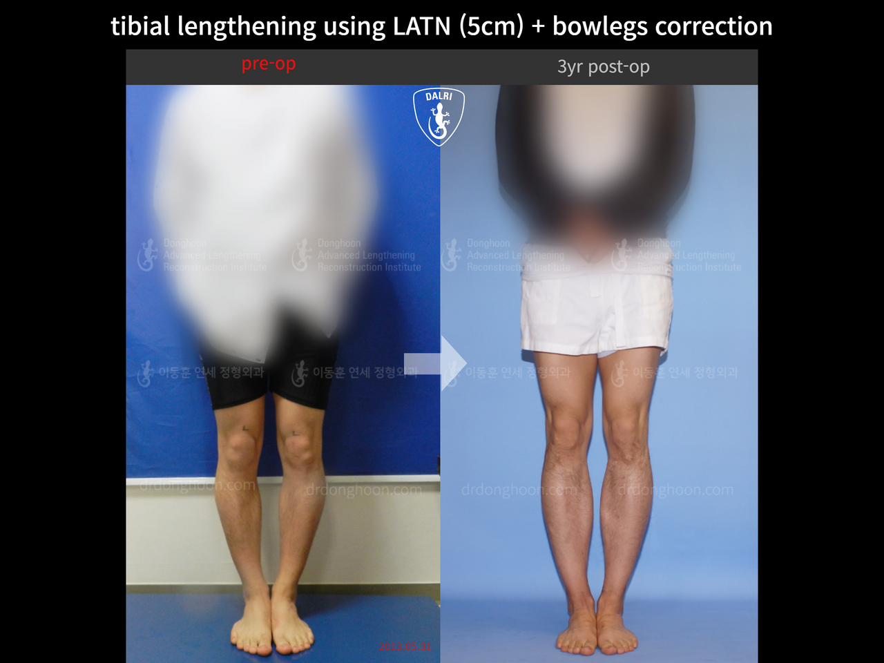 Before and after cll + deformity correction, case 13476494, image 4, Dr. Donghoon institute (DALRI)