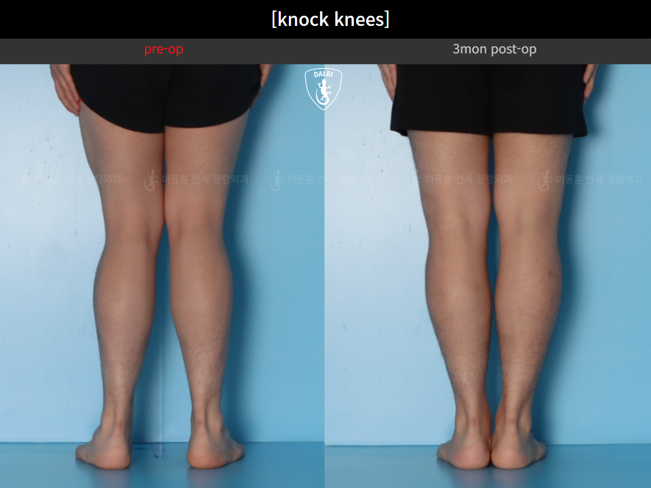 Before and after adult knock knees, case 124642361, image 7, Dr. Donghoon institute (DALRI)