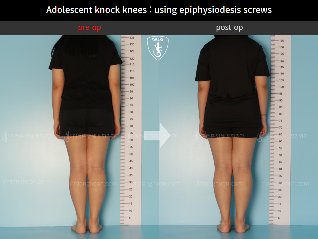 Before and after paediatric & adolescent knock knees, case 11123118, image 2, Dr. Donghoon institute (DALRI)