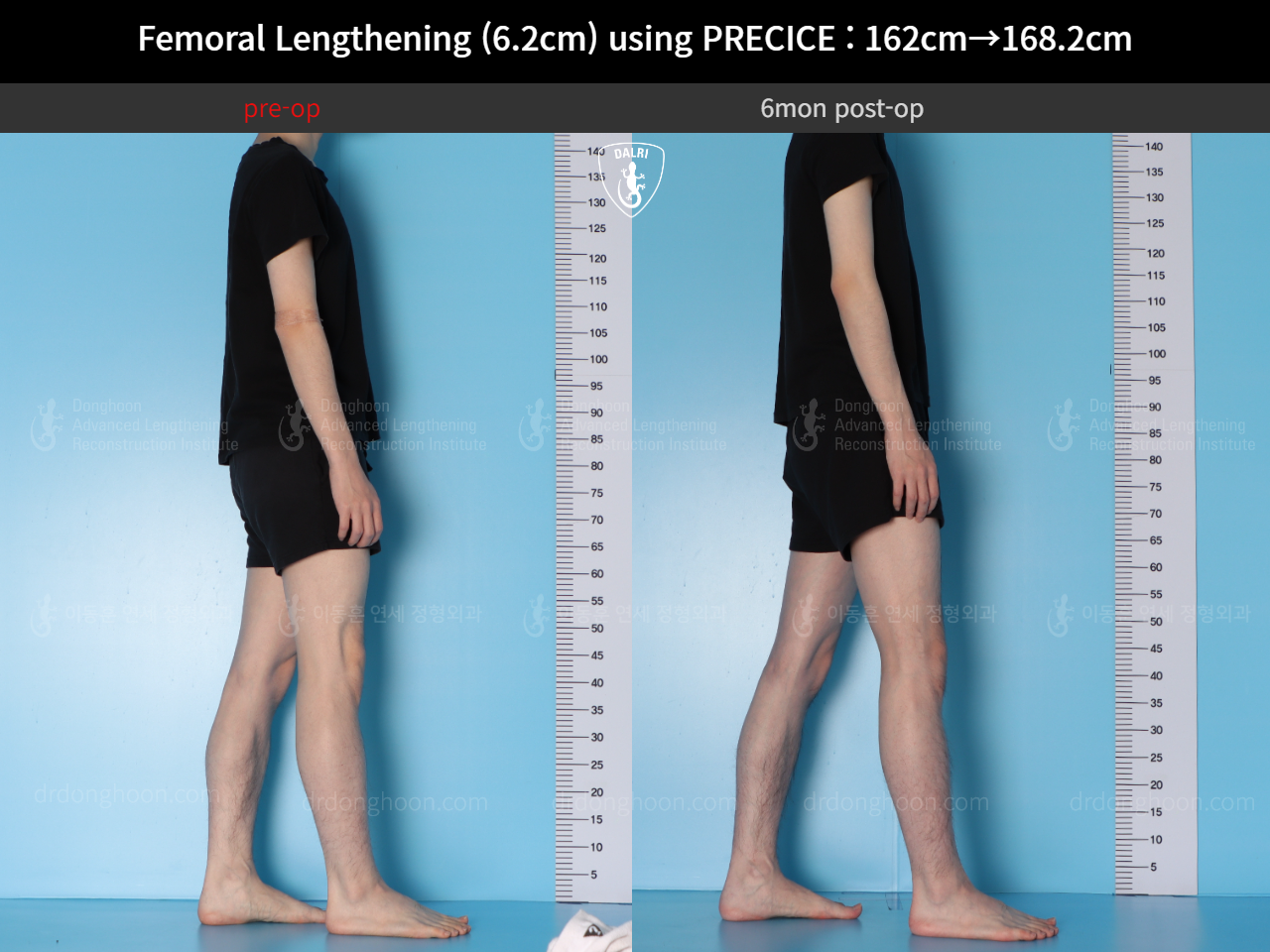 Before and after cll precice, case 15393865, image 5, Dr. Donghoon institute (DALRI)