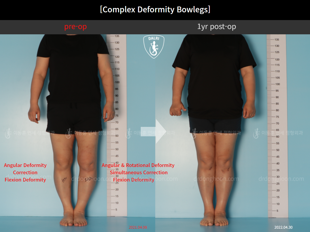 Before and after complex deformity, case 11339608, image 1, Dr. Donghoon institute (DALRI)