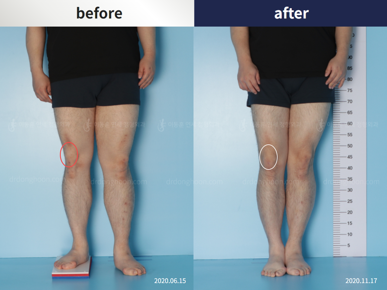 Before and after complex deformity, case 5346191, image 1, Dr. Donghoon institute (DALRI)