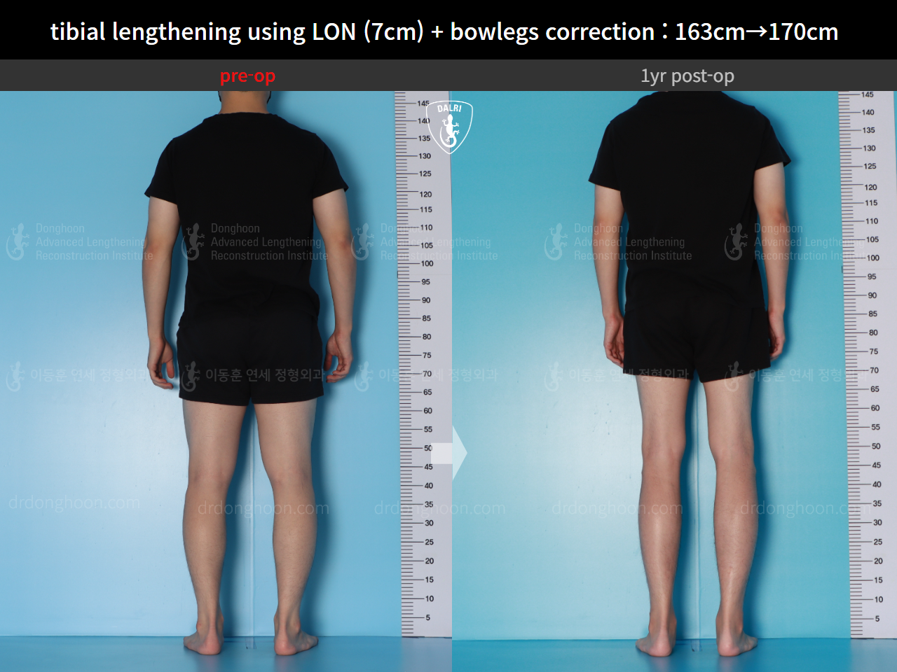Before and after cll + deformity correction, case 16131910, image 4, Dr. Donghoon institute (DALRI)