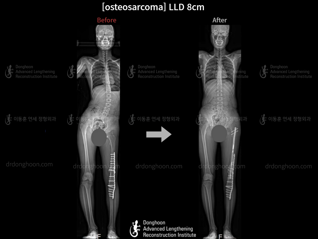 Before and after congenital condition, case 9012803, image 2, Dr. Donghoon institute (DALRI)