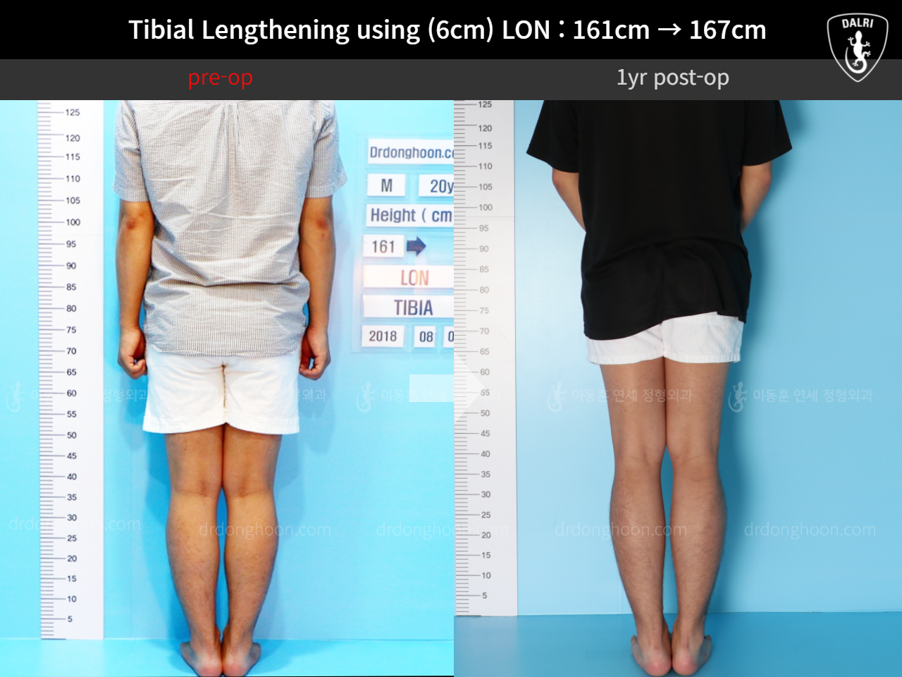 Before and after cll lon, case 11654440, image 4, Dr. Donghoon institute (DALRI)