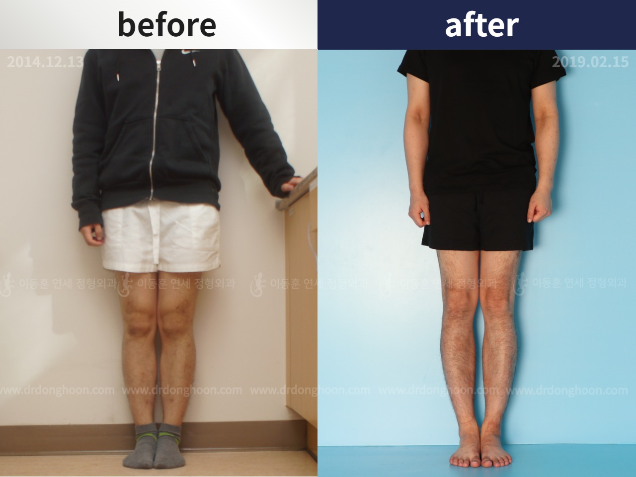 Before and after cll precice, case 4323422, image 2, Dr. Donghoon institute (DALRI)
