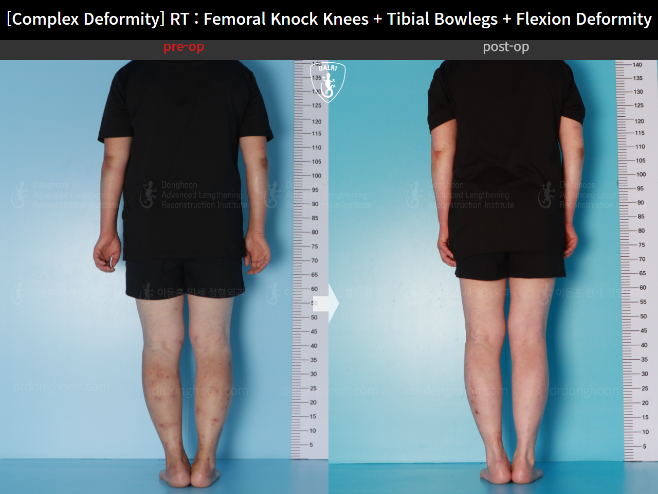 Before and after adult knock knees, case 16507042, image 3, Dr. Donghoon institute (DALRI)