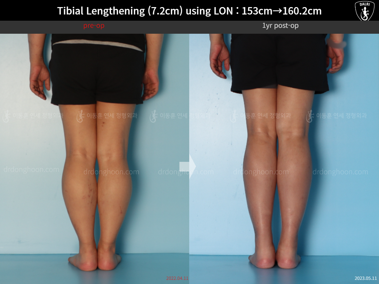 Before and after cll lon, case 15150707, image 6, Dr. Donghoon institute (DALRI)