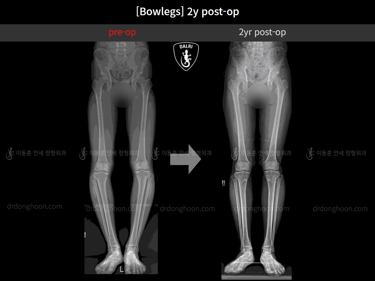 Before and after adult bowlegs, case 4311131, image 5, Dr. Donghoon institute (DALRI)
